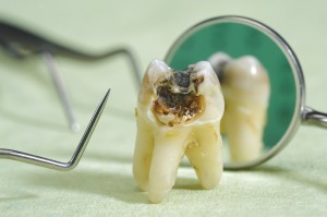5 Things You Didn’t Know About Tooth Decay