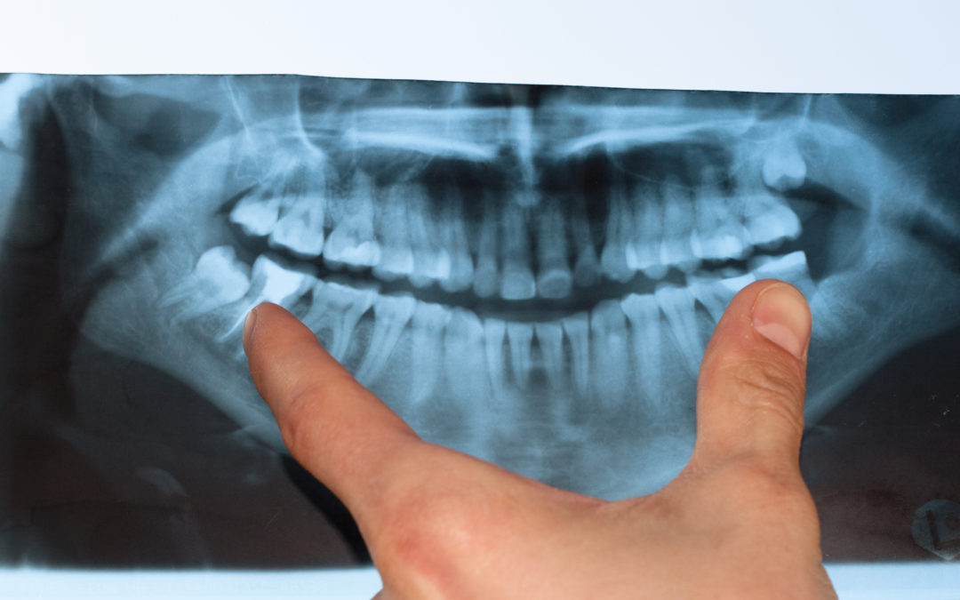 5 Myths About Gum Disease