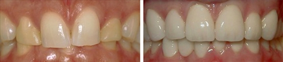 family dentistry canyon trails family dental goodyear az gallerypage porcelain crowns 3