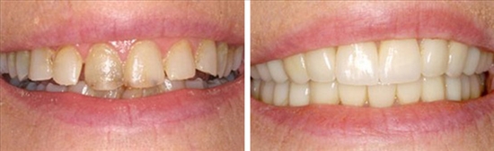 frienldy dentistry canion trayls family dental gallerypage full mouth reconstruction